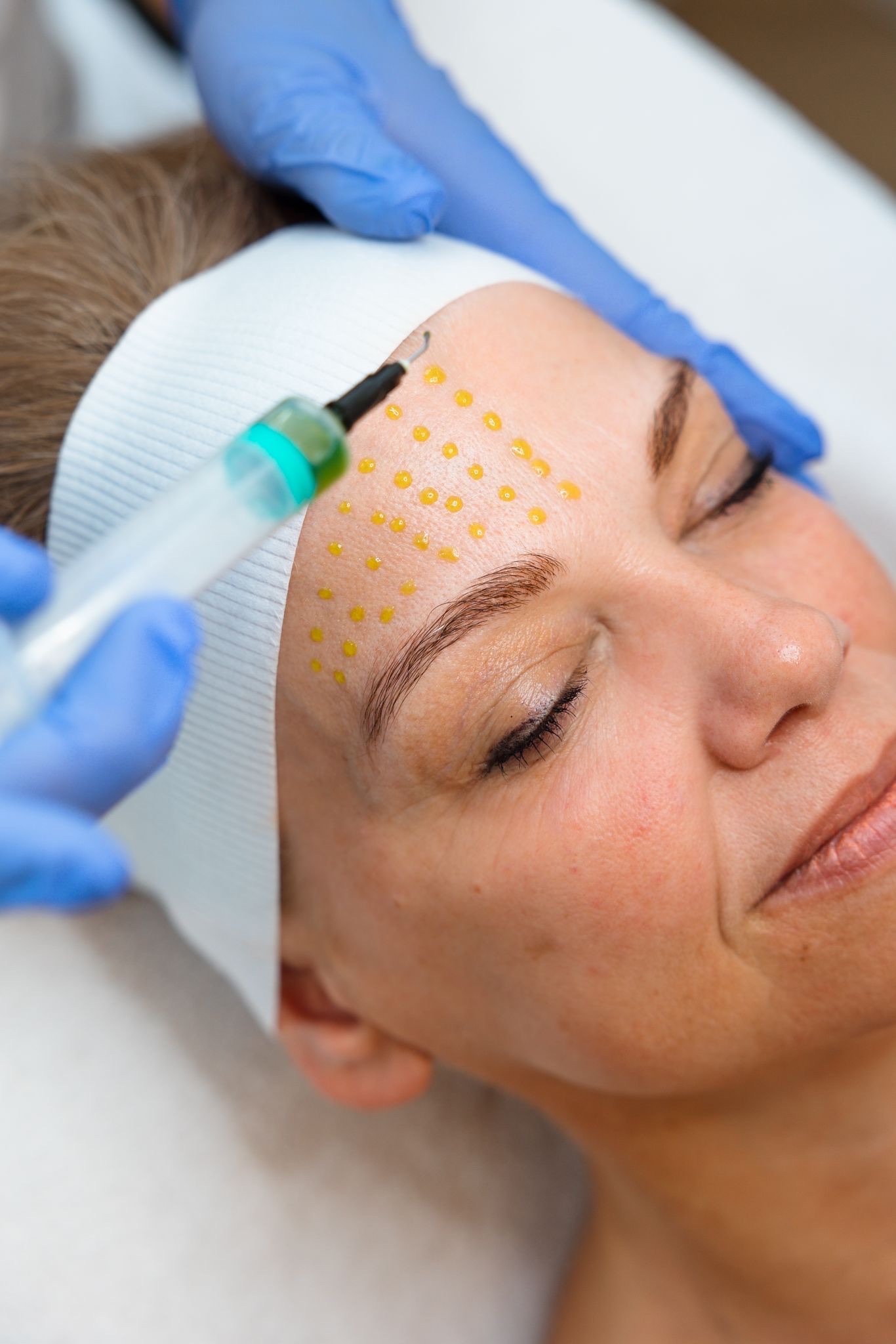 BioRePeel behandeling