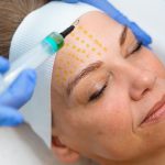 BioRePeel behandeling